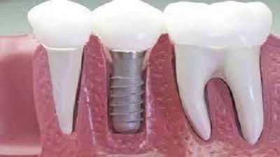 combien implants dentaires peut on poser en une seule fois