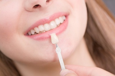 facettes dentaires sans limer les dents