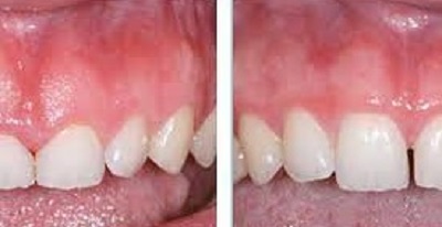 difference gingivectomie et gingivoplastie