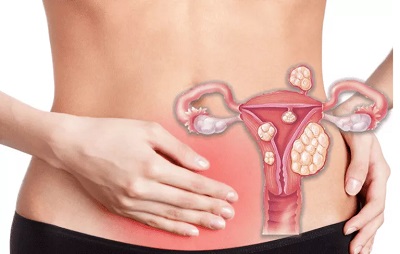 tomber enceinte apres myomectomie