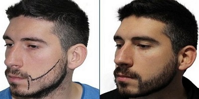greffe barbe apres 10 jours