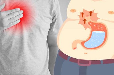reflux gastrique apres bypass