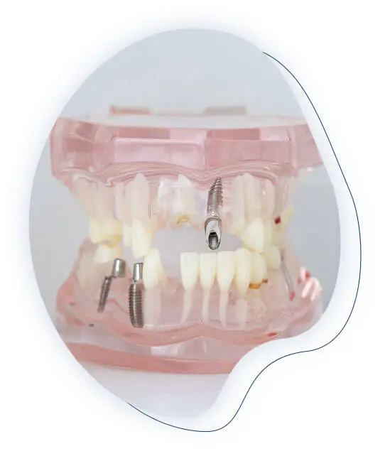 implants all on four