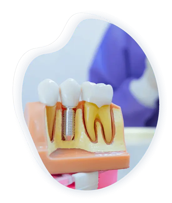 implant dentaire prix tunisie