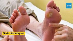Traitement du pied diabétique en Tunisie Thérapies avancées