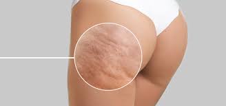 La radiofréquence réduit la cellulite