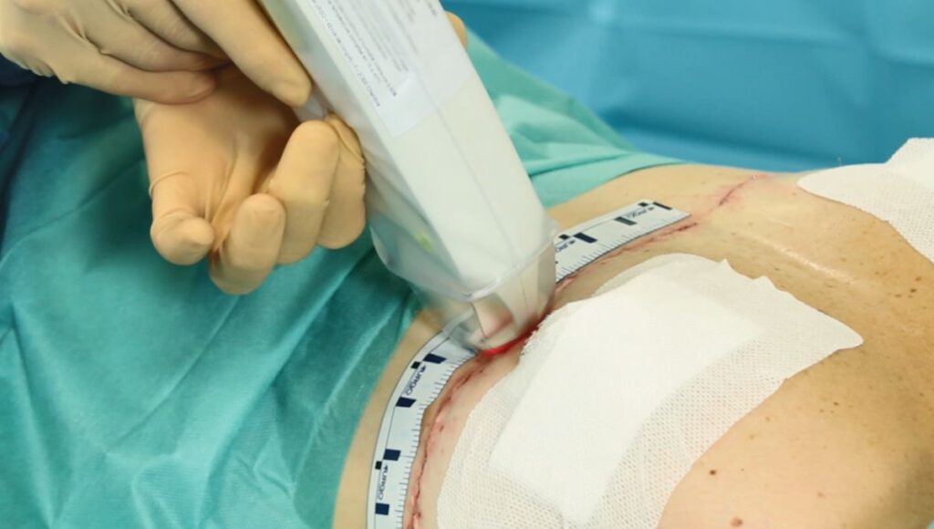 traitement cicatrices postopératoires UrgoTouch