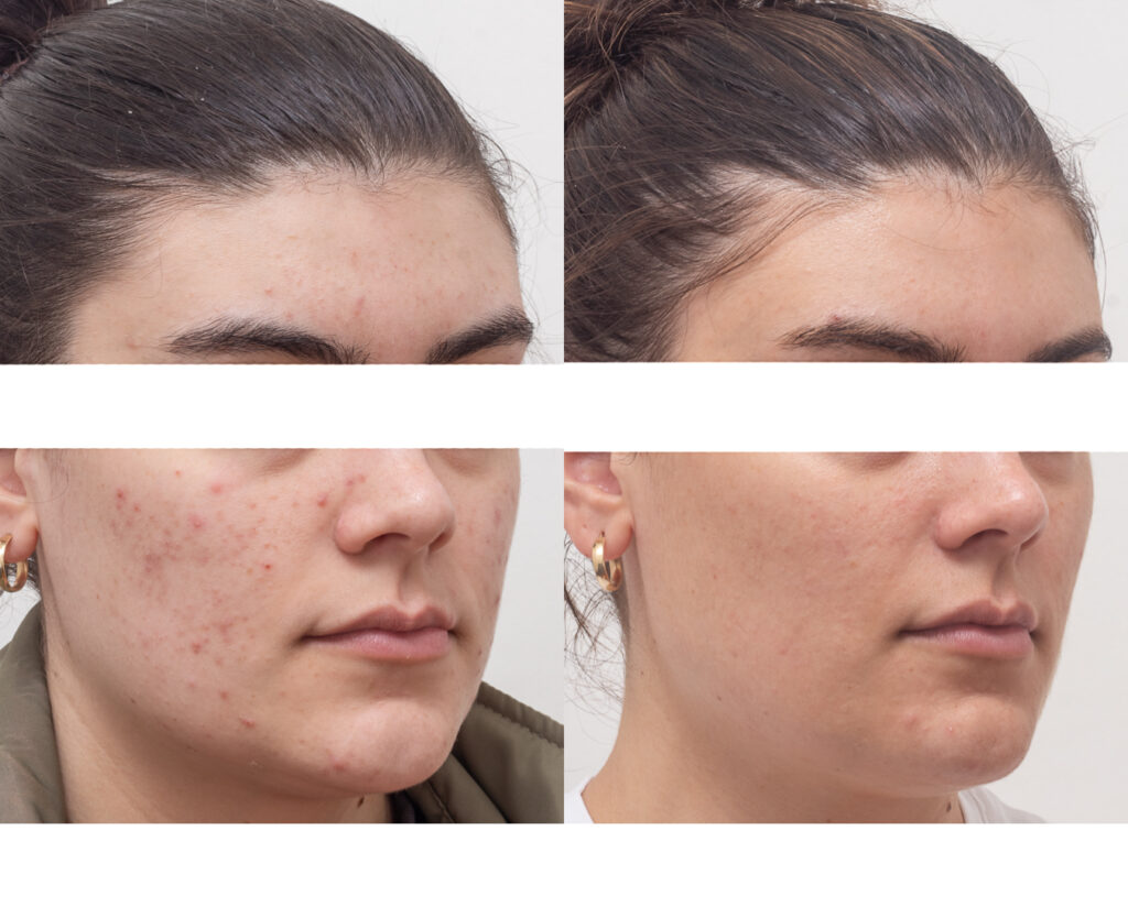 aviclear traitement acne tunisie