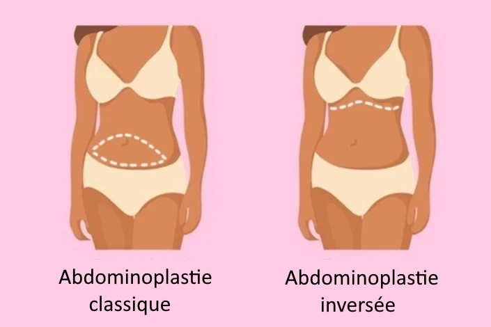 abdominoplastie classique vs inversée