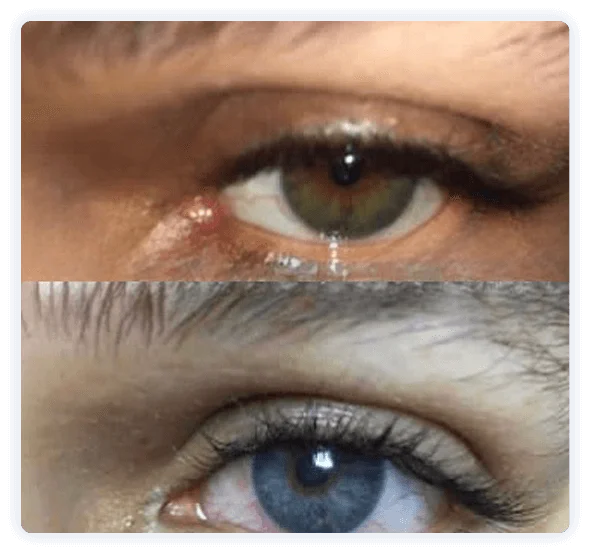 keratopigmentation tunisie prix