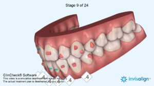 clincheck invisalign
