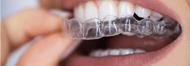 traitement sourire gingival tunisie