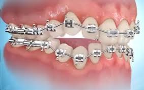 traitement sourire gingival tunisie