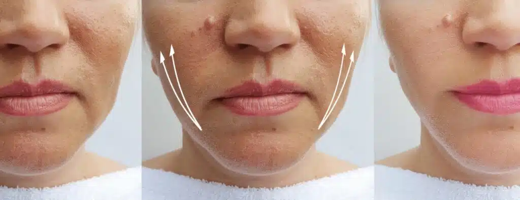 rajeunissement global du visage