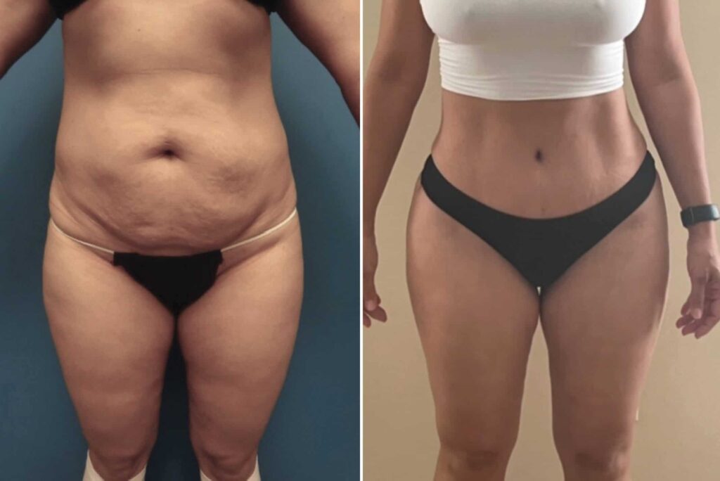 Mommy Makeover tunisie