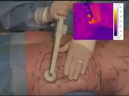 Cryolipolyse BodyTite liposuccion