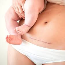 Corriger cicatrice césarienne en Tunisie