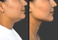 kybella