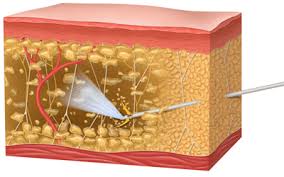 abdominal etching prix tunisie