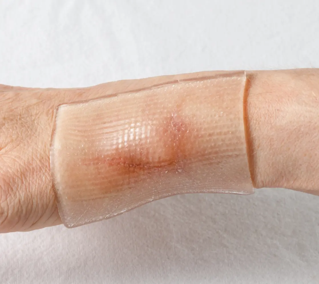 traitement brulures tunisie 