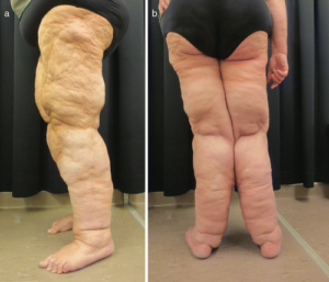 lipoedeme severe tunisie