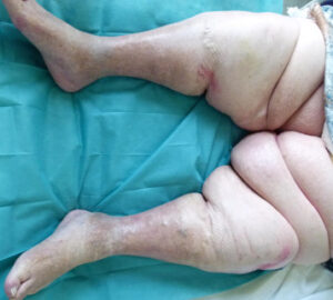 lipoedeme severe