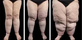 Lipœdème (1, 2, 3 )