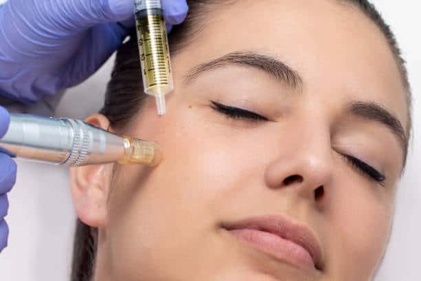 Synergie PRP + Microneedling
