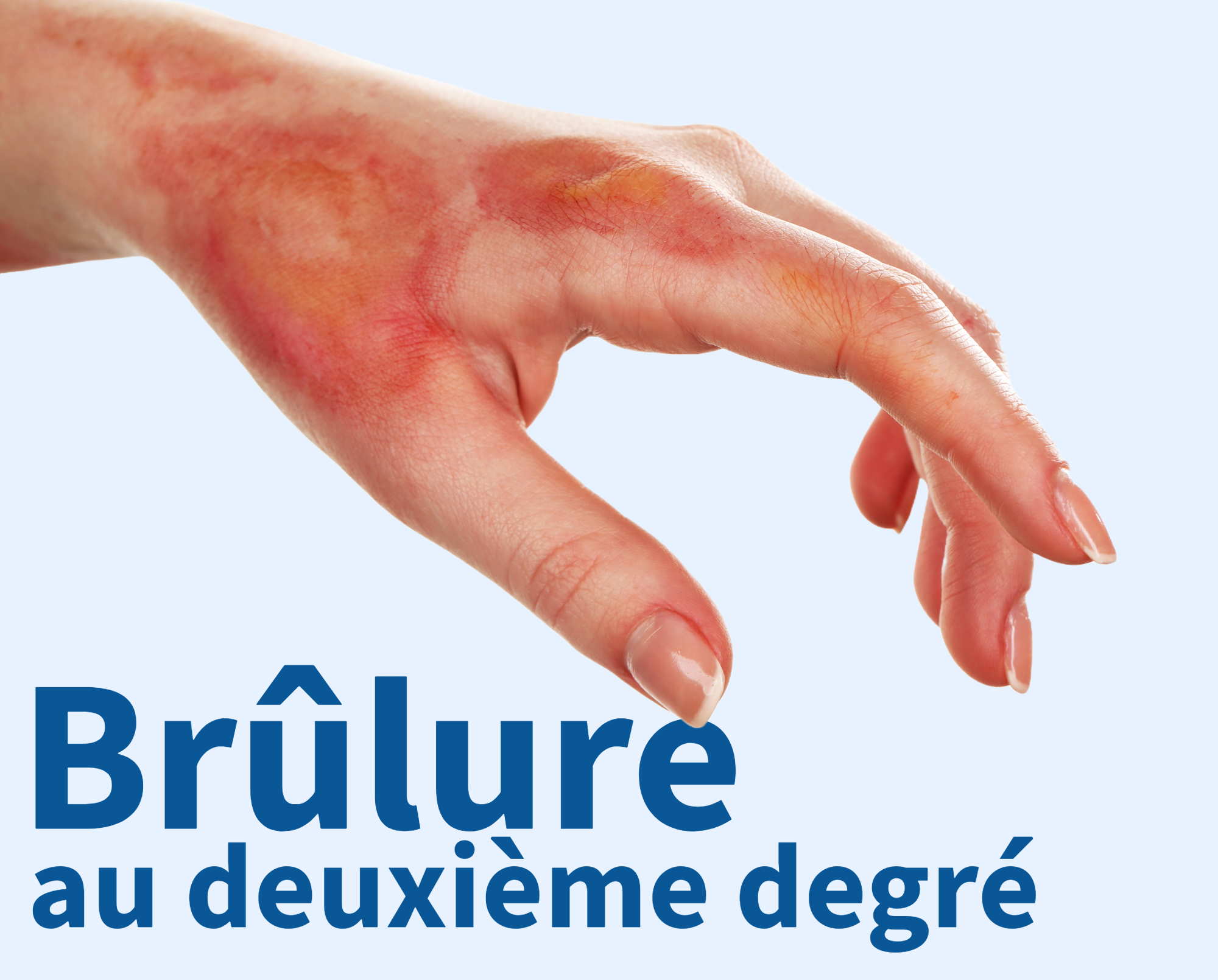 traitement brulures tunisie