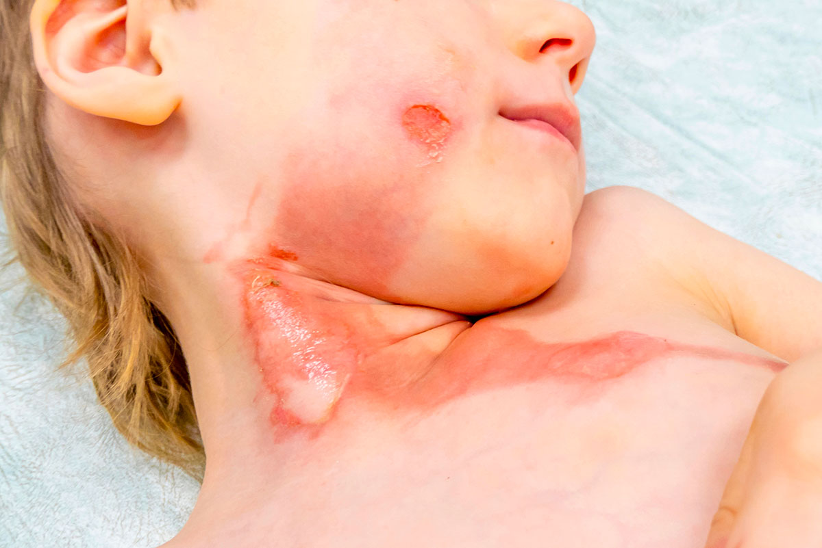 traitement brulures tunisie 