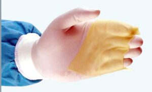 علاج الحروق وإعادة بناء الجلد