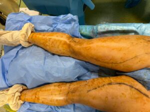 Récupération rapide après chirurgie du lipœdème en Tunisie