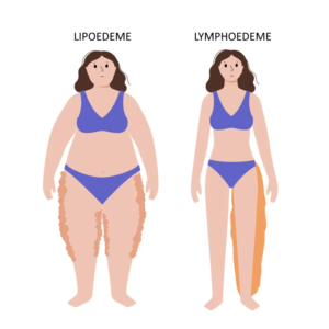 LIPOEDEME LYMPHOEDE