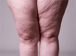 Lipœdème ou cellulite