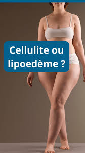 Lipœdème ou cellulite