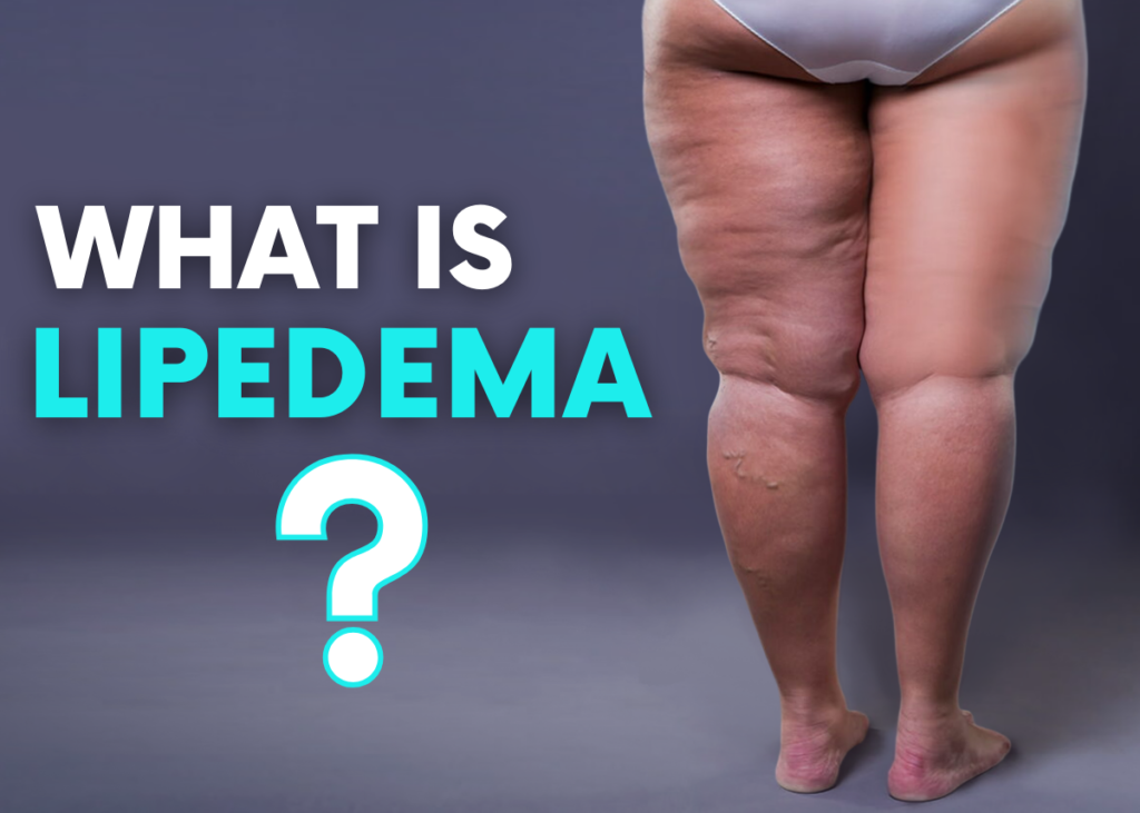 lipedeme