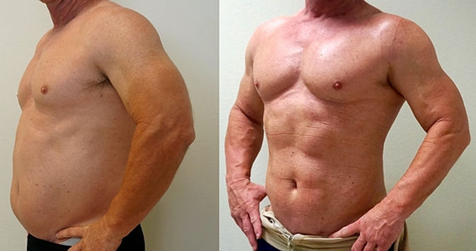 4D Lipo
