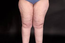 Chirurgie du lipœdème techniques spécifiques et approche codifiée