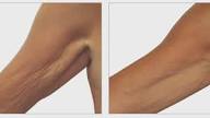 Arm tightening without surgery