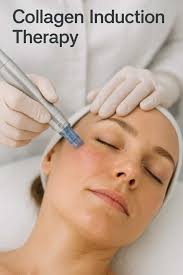 Collagen Induction Therapy