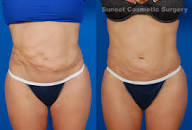 Revision Liposuction