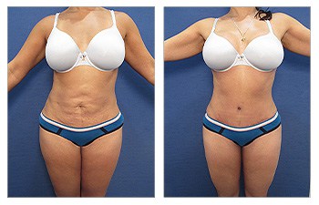 Liposuccion de révision