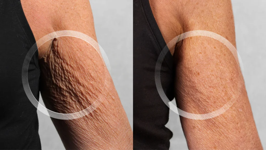 Arm tightening without surgery