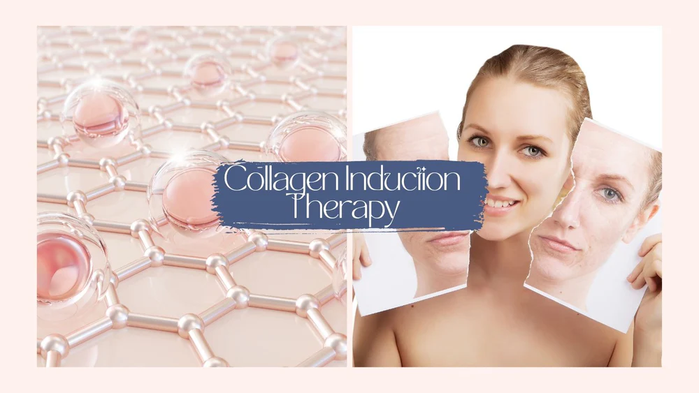 Collagen Induction Therapy