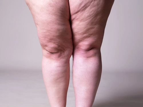 Lipedema treatment in Turkey