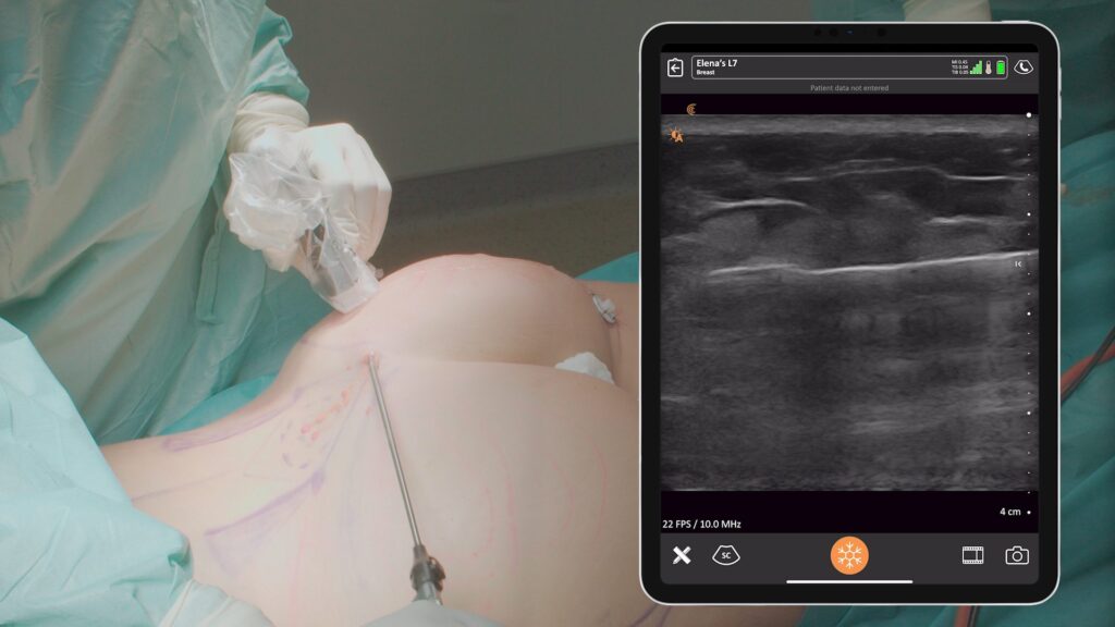 smart bbl safe sous echographie
