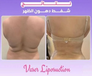 تقنية شفط الدهون بالفيزر