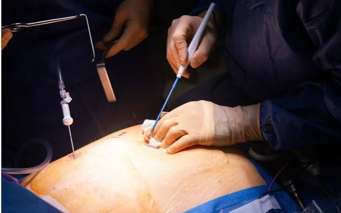 Chirurgie bariatrique et traitements GLP-1