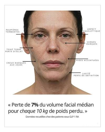 corriger ozempick face
