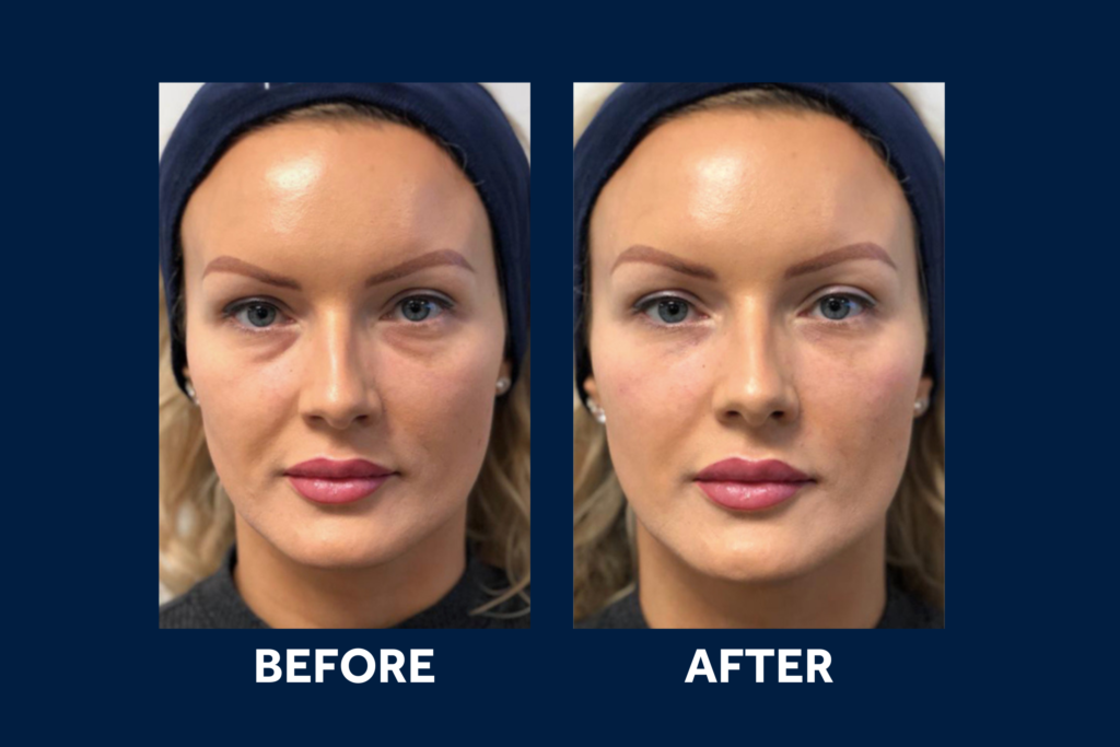 Tear Trough Filler
